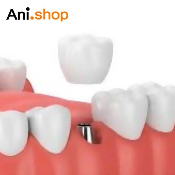 چسب ترکیبی روکش ایمپلنت دندان 4 میل برند هیوج - Image 3