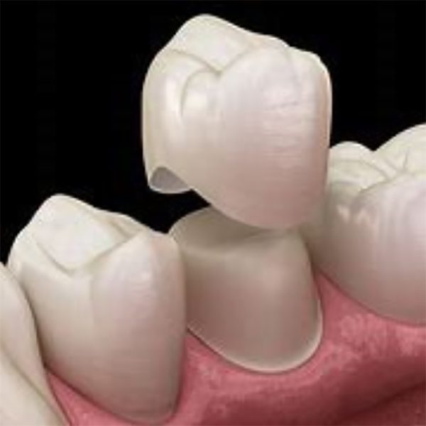 چسب روکش دندان (پودر+مایع) Adhesor - Image 3